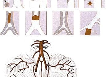 Vertebrobaziller Yetmezlik