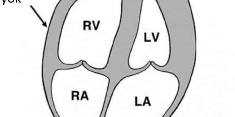 McConnell’in işareti nedir?