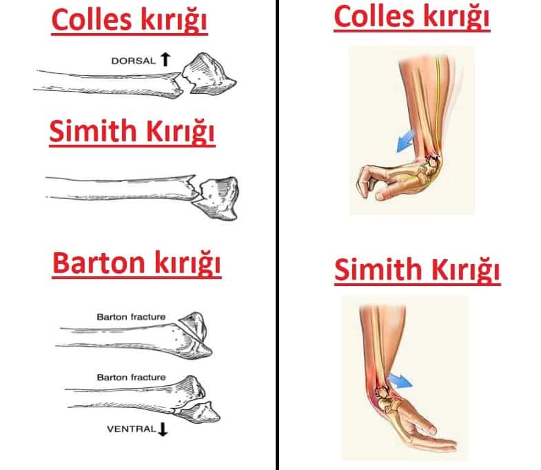 colles, barton, simith kırığı