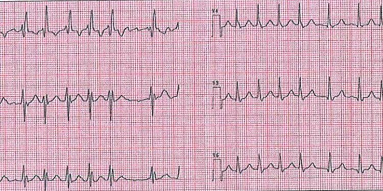 EKG Soruları 038