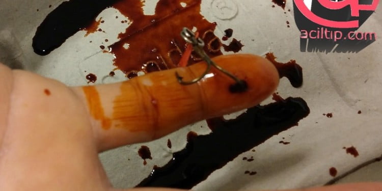 Olta iğnesi çıkarma teknikleri