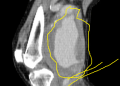 Popliteal arter anevrizması