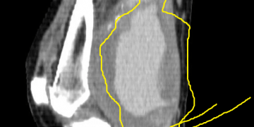 Popliteal arter anevrizması