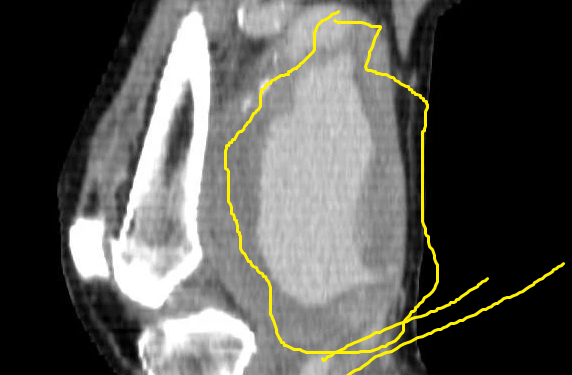 Popliteal arter anevrizması