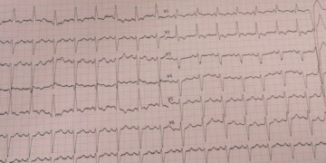 COVID-19’da EKG