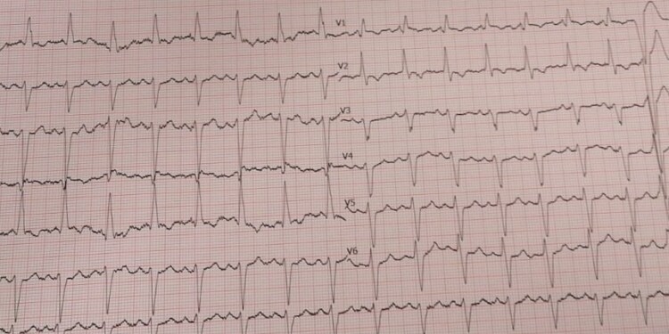 COVID-19’da EKG
