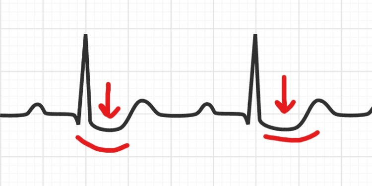 Digoksin etkisi ve posterior miyokard enfarktüsü