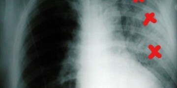 Tek taraflı pulmoner ödem olabilir