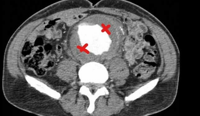 Anevrizma ve yaygın damar içi pıhtılaşma