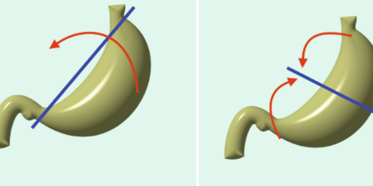 Gastrik Volvulusun EKG Üzerine Etkisi